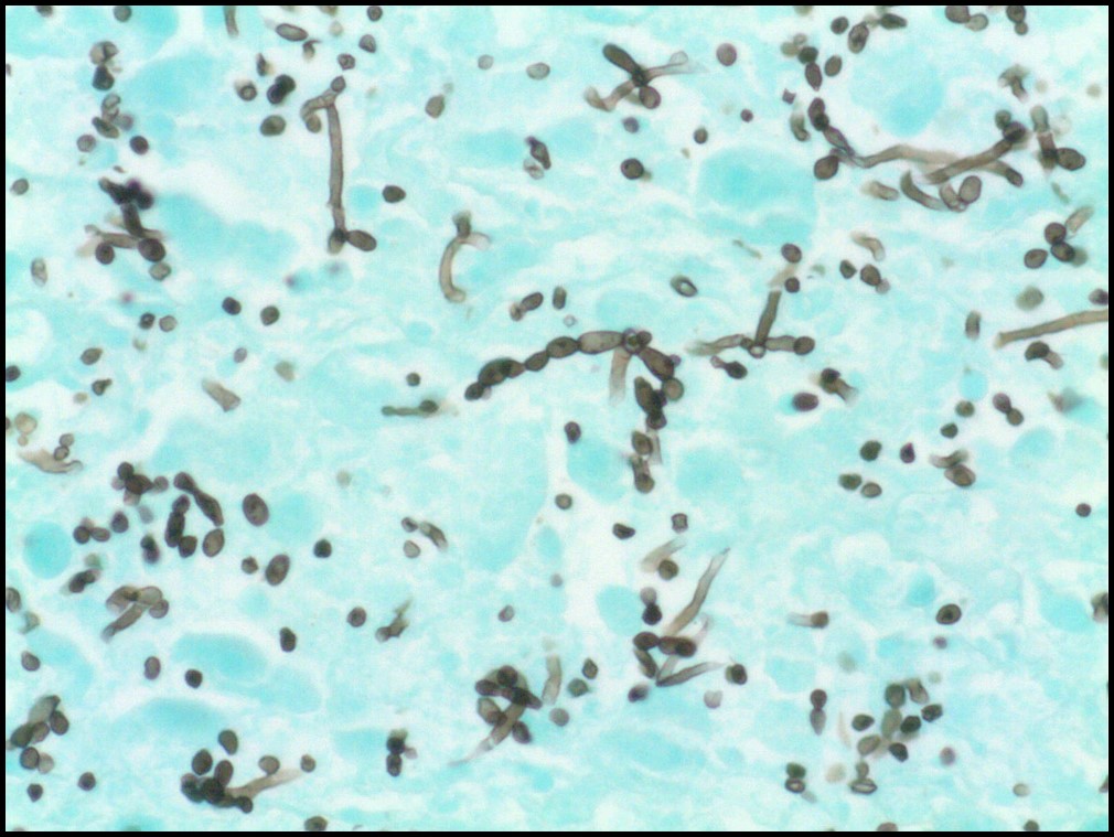 Answer to Questions: 51 year old man with worsening pneumonia while hospitalized