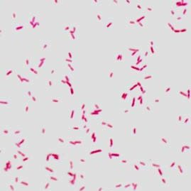 Case Report: 37 year old with injection drug abuse and endocarditis