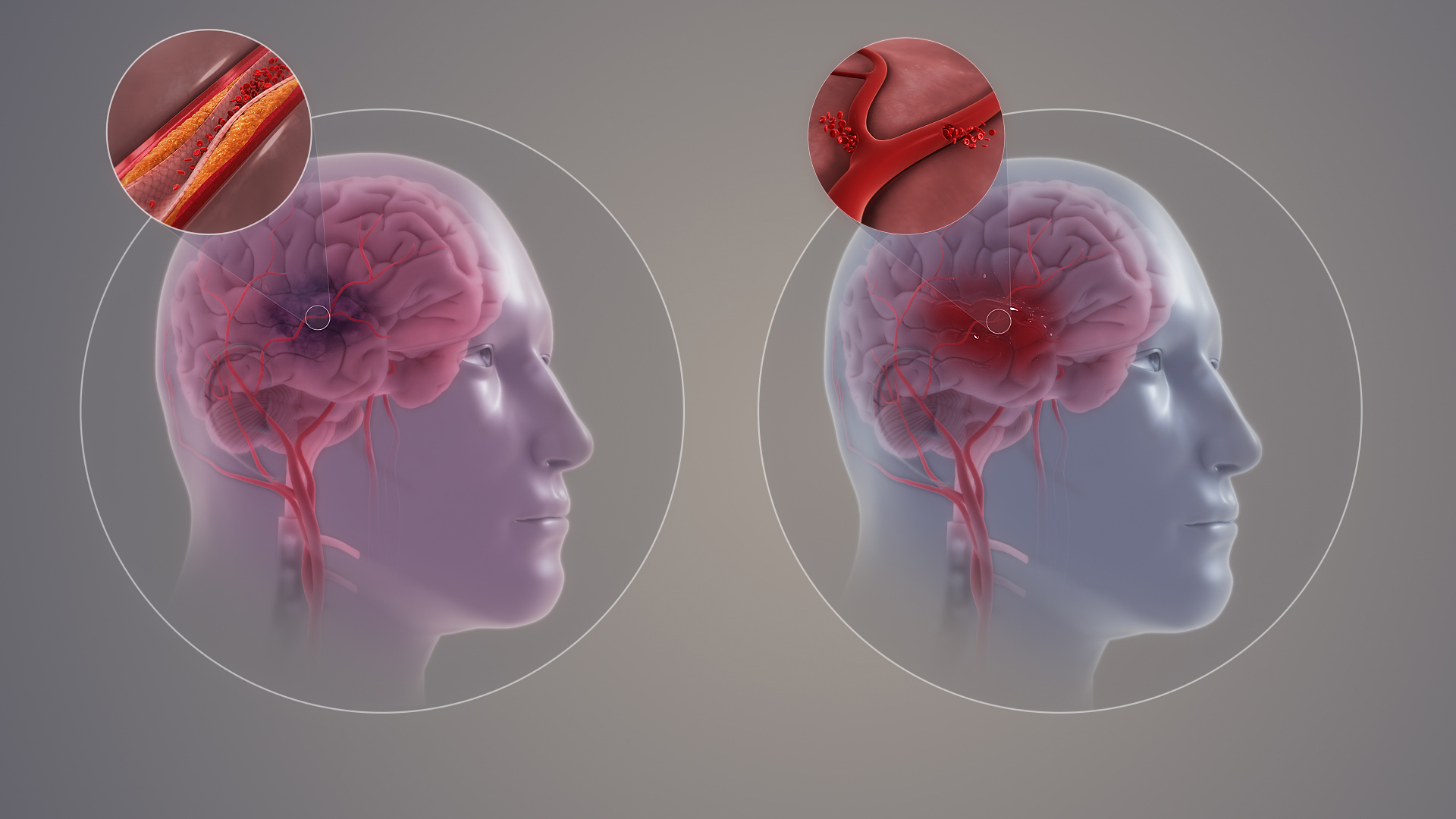 How to Prevent The First (and Next) Stroke