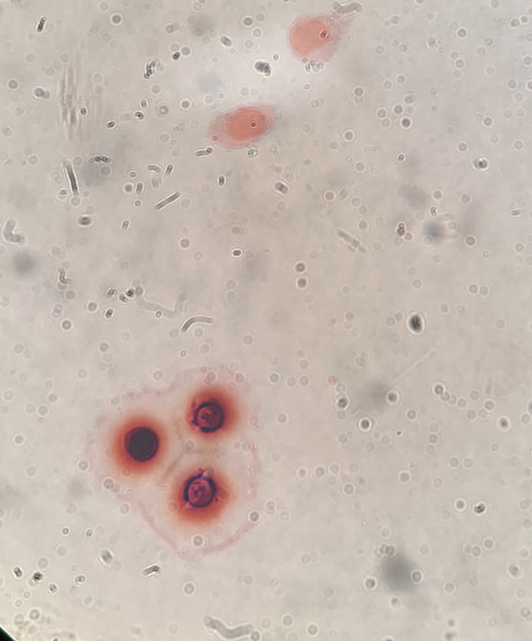 59 year old with Meningitis, Lung Cancer, Confusion, and Brain Lesions