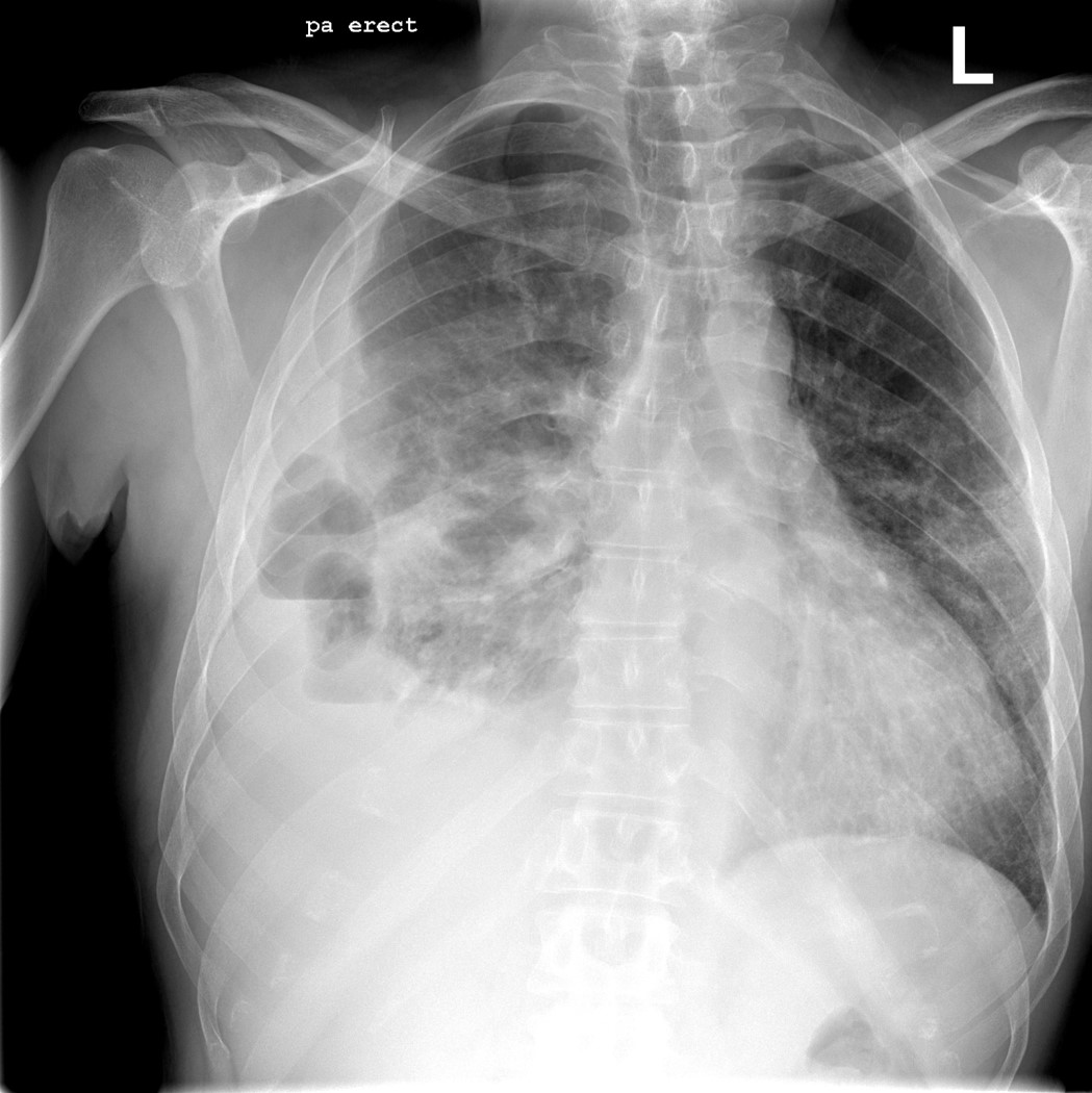 Case Report:  51 year old man with worsening pneumonia while hospitalized